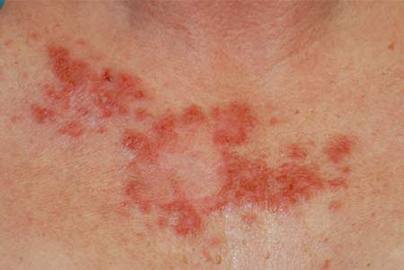 Brief overview of skin cancer diseases