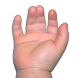 Causes And Treatments For Syndactyly Of the Fingers