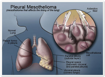 Are Pleural Diseases Fatal?