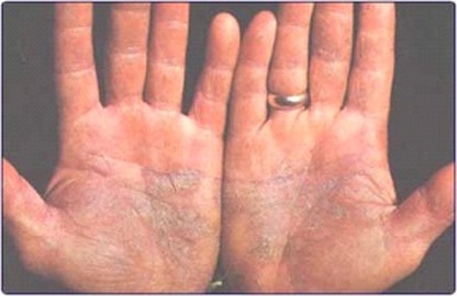 About Yeast Skin Diseases Fungal Infections