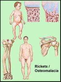 Five Types Of Bone Diseases	