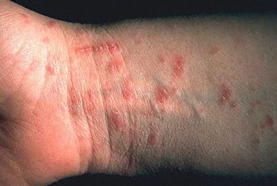 What you need to know about fomite scabies treatment