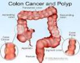 What Factors Affect the Survival Rate Of Colon Cancer