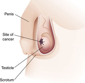 Leadng Causes Of Cancer in Men