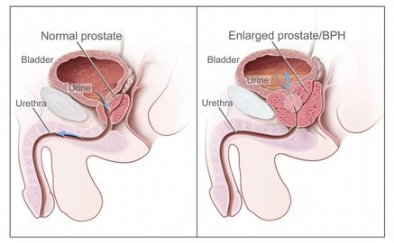 Brief overview of prostate cancer and prostatic diseases
