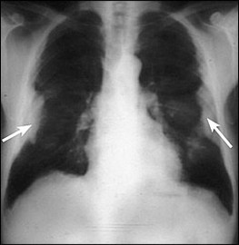 Information About Diseases Of The Lung