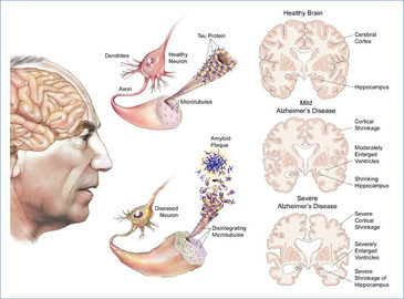 What Are Disorders Mental?