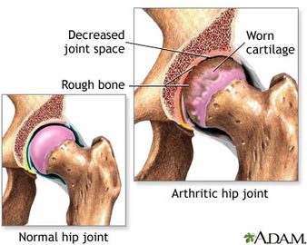 Information About Joint Diseases