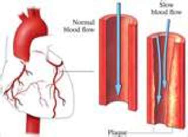 How To Prevent Artery Diseases	